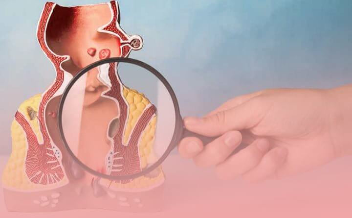 اقدامات لازم در دوران نقاهت عمل فیستول 2 فیستول چیست؟